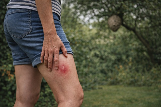 Femme avec une trace de piqûre de frelon sur la jambe