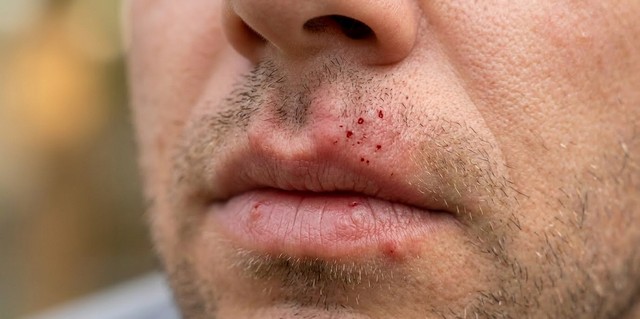 Frelons asiatiques piqûre sur la bouche