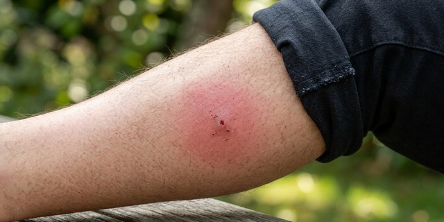 Frelons asiatiques piqûre sur le jambe