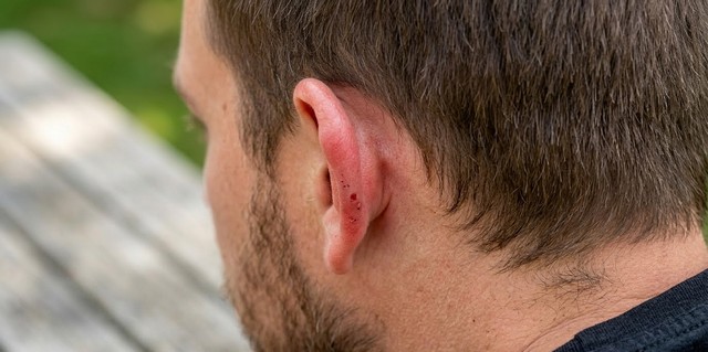 Frelons asiatiques piqûre sur l'oreille