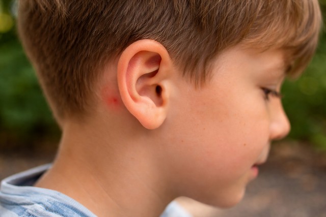 Piqûre de moustique derrière l'oreille d'un enfant