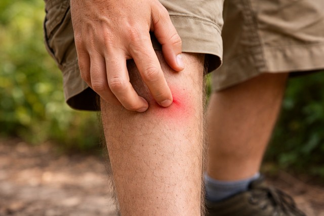 Piqûre de moustique sur la jambe d'un homme