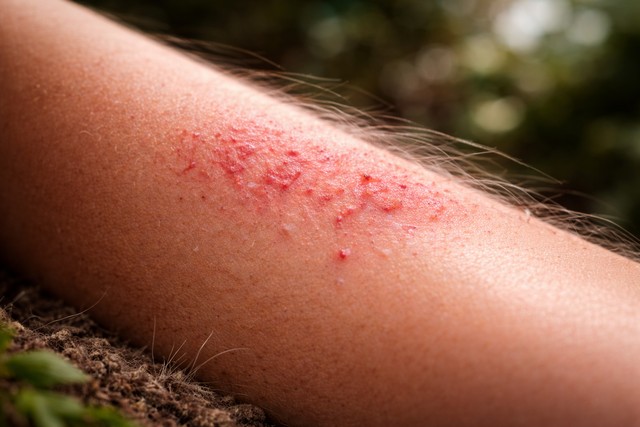 piqûre chenille processionnaire