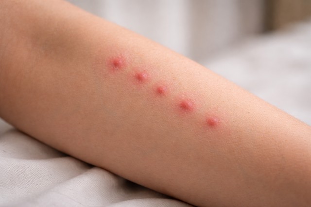 piqûre de punaises de lit