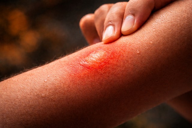 piqûre frelons asiatiques