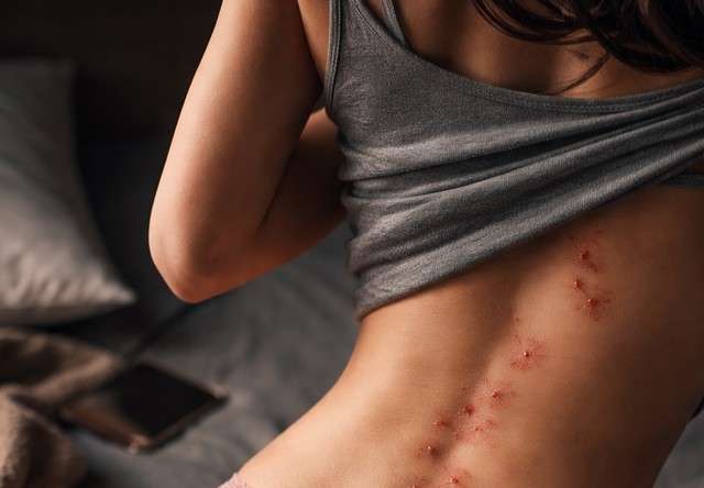 piqûre punaises de lit