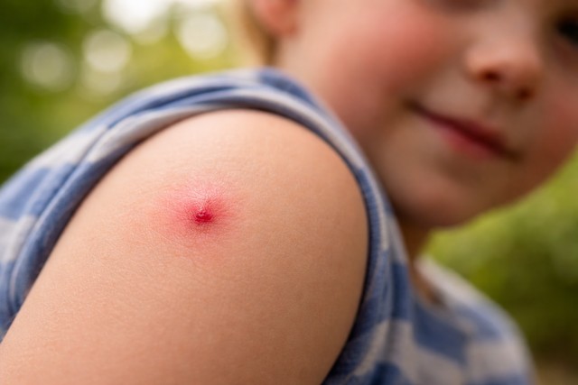 piqûre de guêpes chez l'enfant